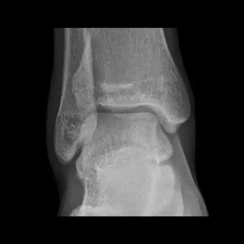 请教各位:10579-右踝关节正侧位片