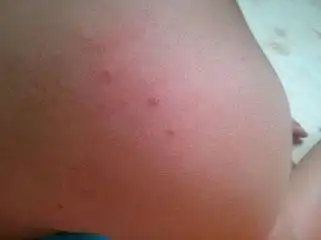 【一期梅毒图片】_症状_治疗方法_苹果绿