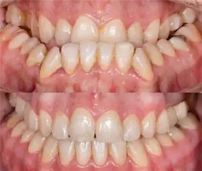 正畸还有难度费吗?只听说过方案收费不知道牙套还有难度费!-医秀网