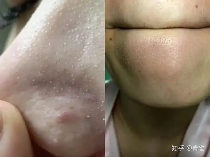 角栓就跟树根一样,上面枝繁叶茂长着