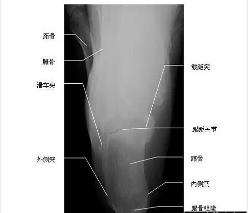 跟骨-x线片-解剖图片