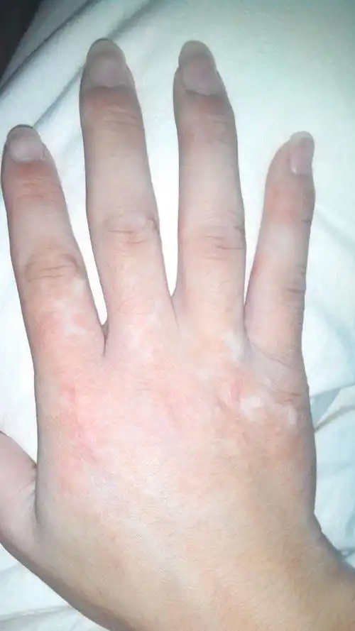 手背上那白斑能不能治好嘛