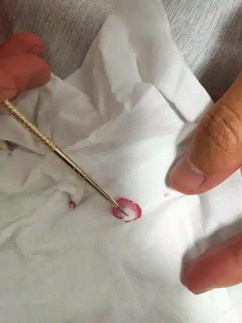 鸡眼大作战治疗鸡眼从头到尾图片大放送小姐妹们需要的看过来