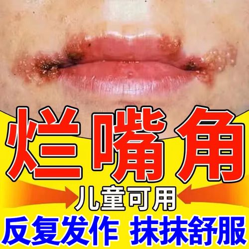 唇炎唇膏慢性唇炎干裂脱皮上火起泡口角炎成人儿童嘴唇干裂 单盒[不