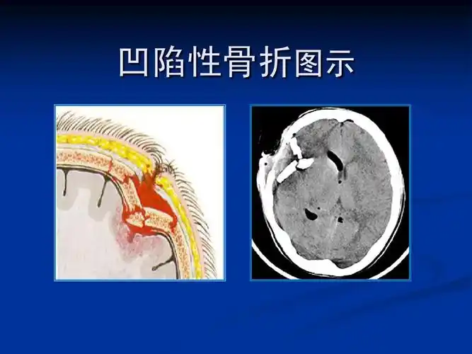 医学教育 凹陷性骨折图示