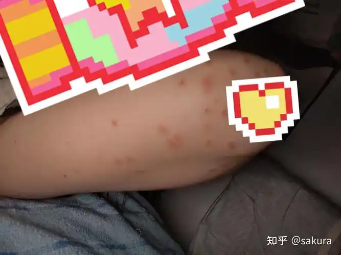 丘疹性荨麻疹? - 知乎
