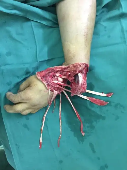 手术中照片,伸肌腱撕脱,腕关节囊破损,腕骨脱离,尺,桡骨远端外露,血管