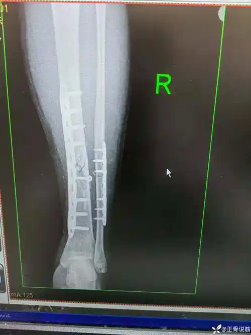 胫腓骨骨折手术一例