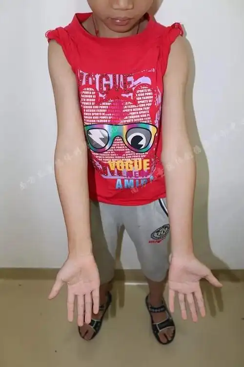 每日病例分享x2左肘内翻畸形