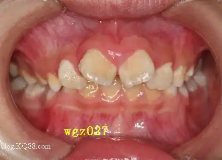 八字牙图片(八字牙图片大全)