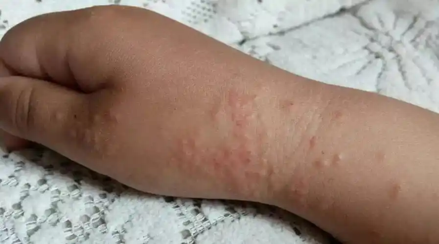 沙土皮炎又叫青少年丘疹性皮炎, 摩擦性苔藓样疹等,是夏秋季节儿童