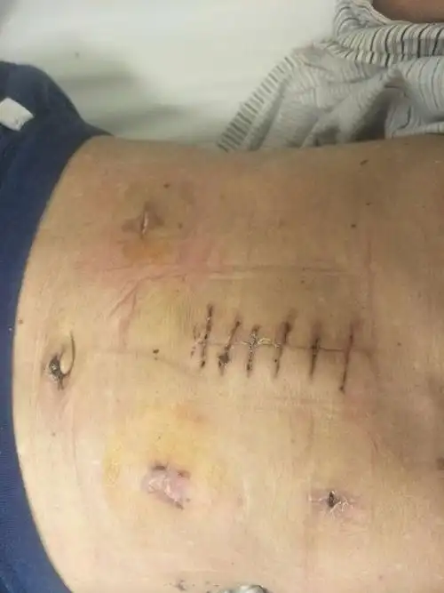 涉县医院普外科完成一例腹腔镜肝右后叶扩大切除术