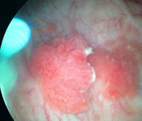 肾盂,输尿管,膀胱肿瘤-----警惕老年人的突发血尿
