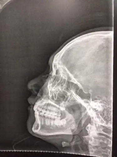 本人最近和别人发生打架事件,致使本人鼻骨骨折.