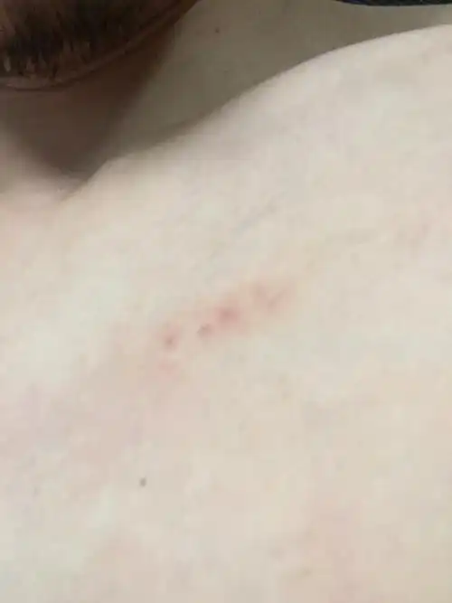 求鉴定这是吻痕还是擦伤之类的?