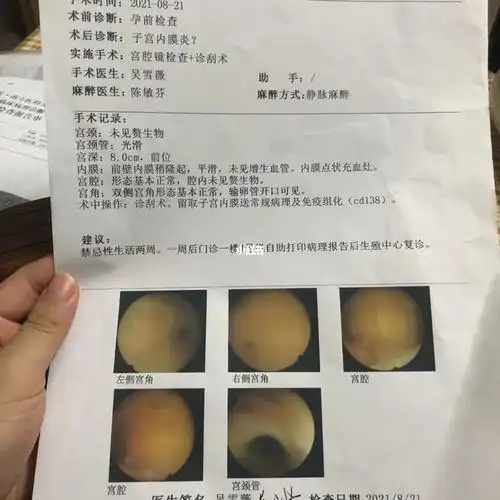 取卵后宫腔镜结果