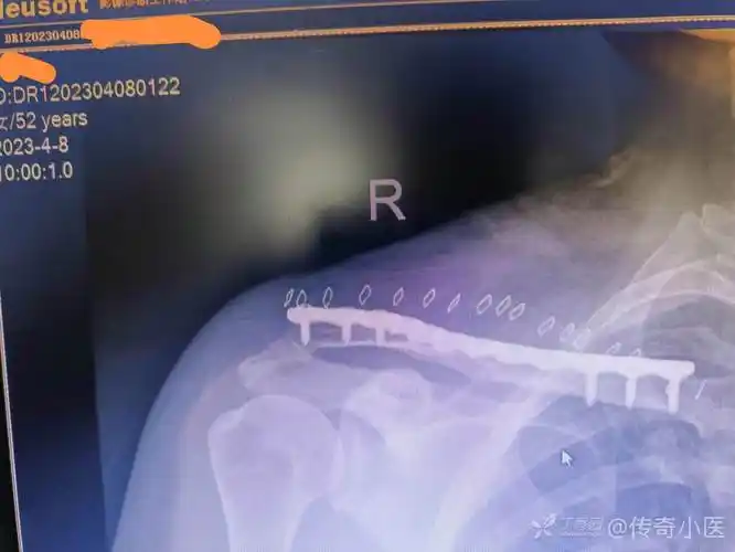 锁骨锁定钢板nice结复位固定锁骨中段粉碎性骨折