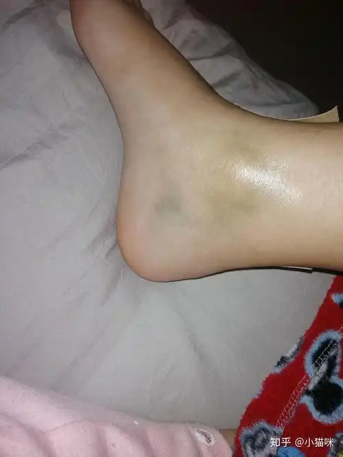 脚崴了后有积液怎么办 脚崴了有积液了是不是就好不了了