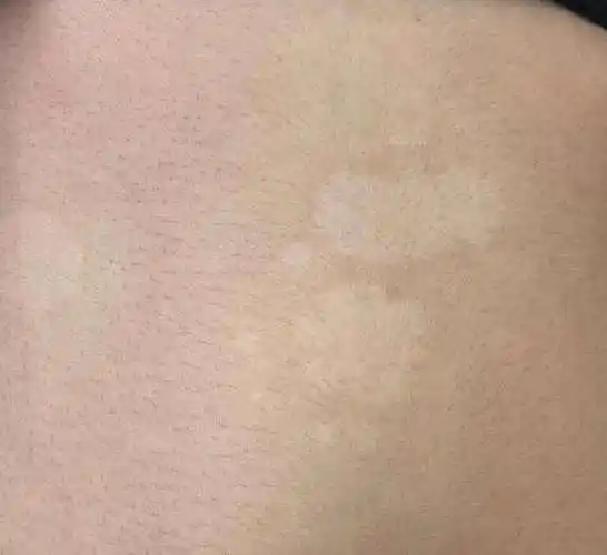 身上出现白斑是怎么一回事