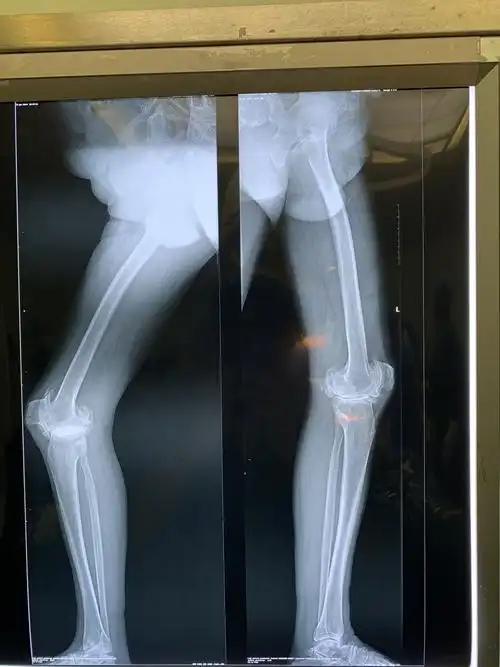 一例外翻,屈曲挛缩伴僵硬膝tka分享 安医附院张辉