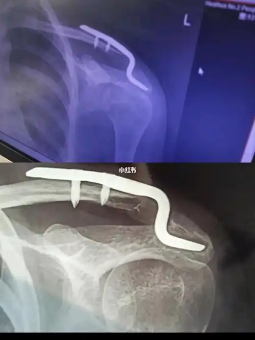 锁骨骨折术后一年虽然一个小骨折但是痛苦却不小骨折后那种无奈的感觉