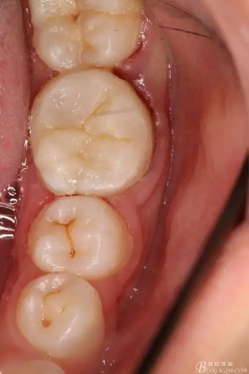 六龄牙都坏这样了还能怎么做