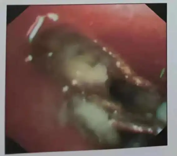 患者咳嗽,痰血,怀疑是肺癌,"凶手"竟是一块辣椒皮!