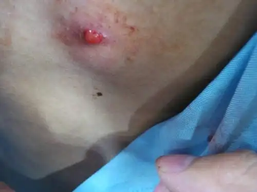 胸部长了个疙瘩,这是什么