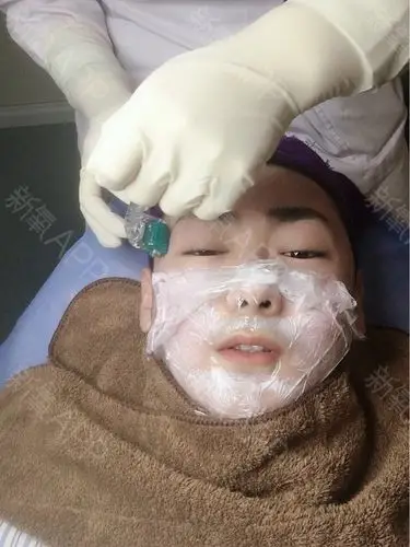 thlala黄金微针第1天美丽日记