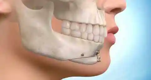 下巴短小后缩怎么办哪些情况适合做下巴截骨前移手术