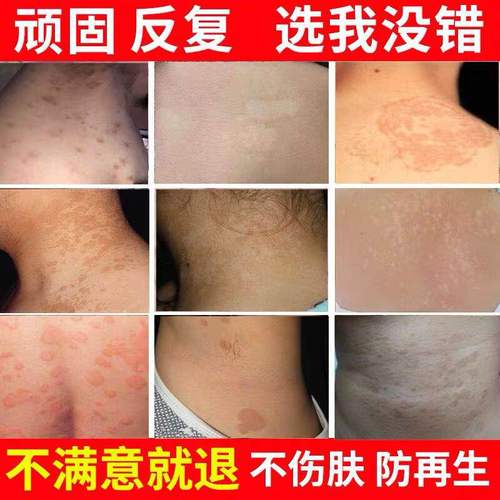 热销好药膏_灰黄霉素软膏真菌感染灰黄霉素外用药膏辉煌霉素软膏买2送