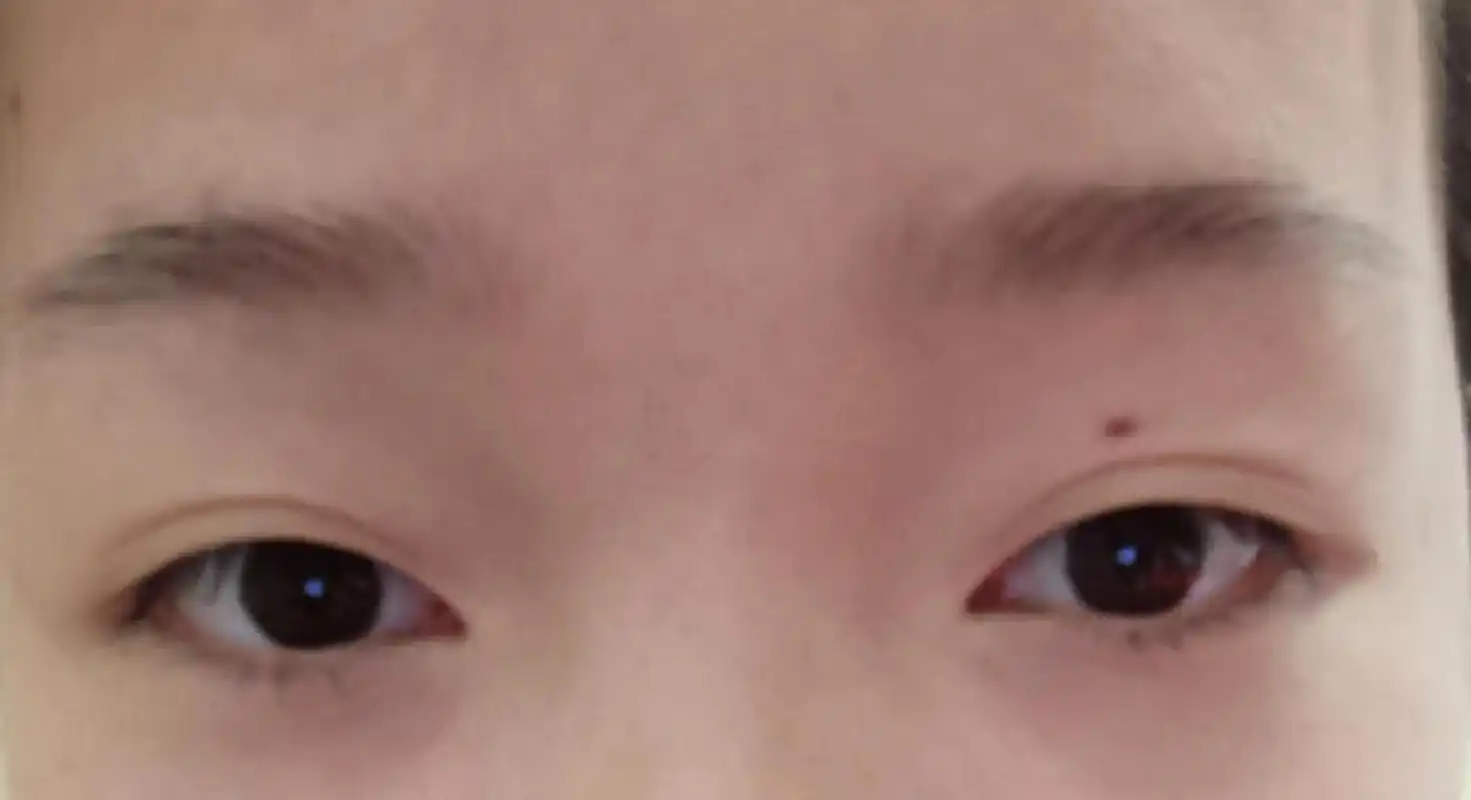 右眼皮突然长痣是代表什么