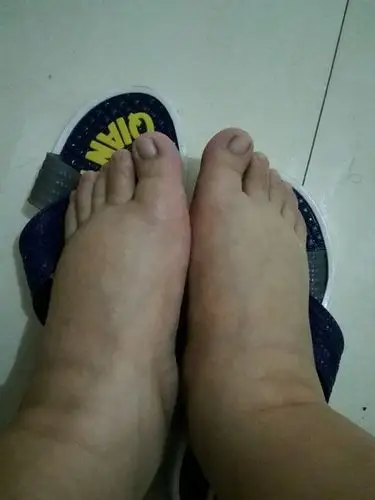 谁有我脚肿腿肿