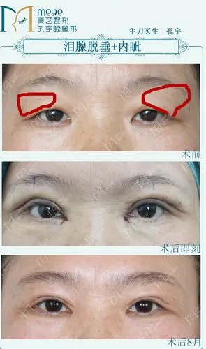 都可以通过手术方法矫正,手术将眶隔脂肪切除后复位固定,泪腺脱垂一定