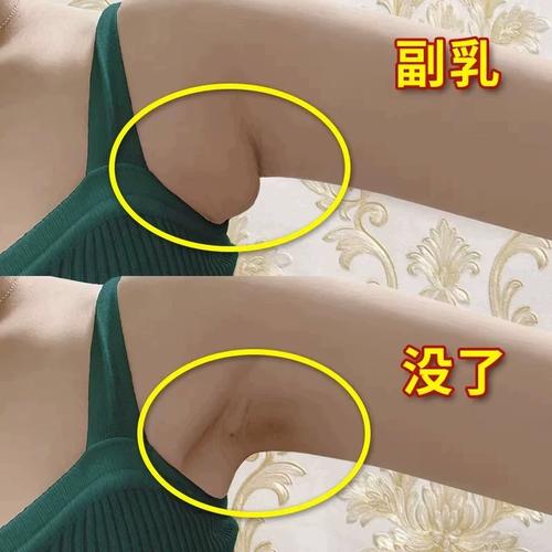 【屈臣氏热卖推荐】副乳消除贴腋下淋巴肿消散药贴去副乳神器