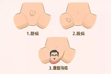 疝气的症状主要有机体表面有可复性包块,一般伴有坠胀,酸胀,胀痛的