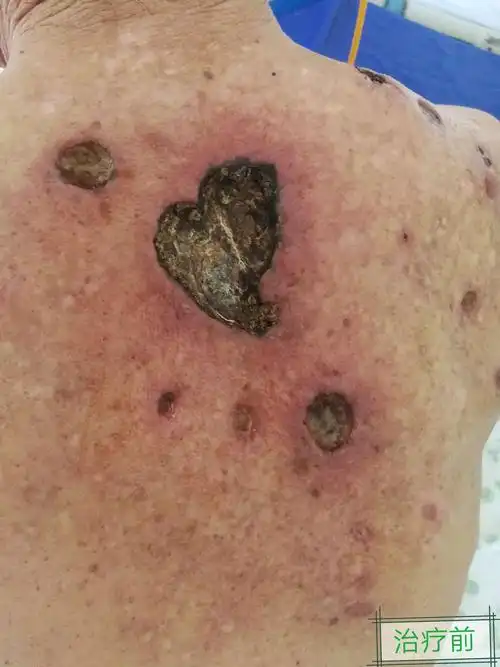 坏疽性脓皮病诊治1例