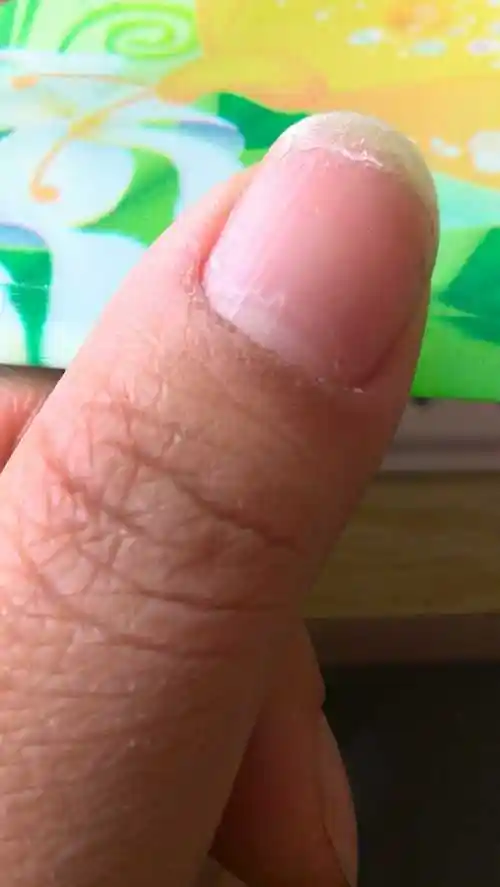 指甲总这样起层,是缺钙嘛