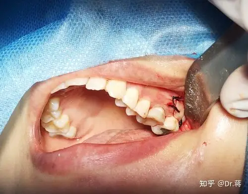 复杂智齿2例