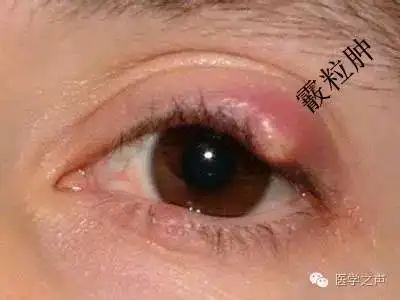 麦粒肿vs霰粒肿傻傻分不清楚