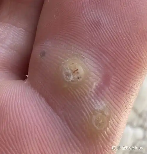 跖疣治疗过程快完全治愈了多图高能慎点