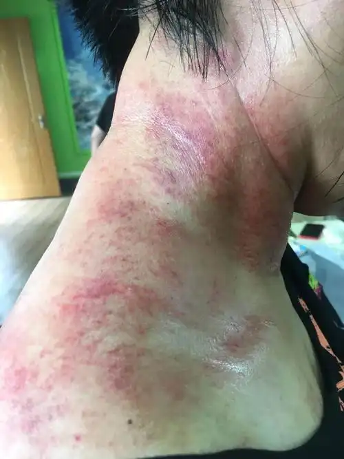 9月26日早班/7人颈部刮痧图