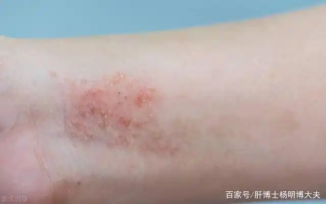 春季过敏,肝病患者如何防治皮肤病问题?