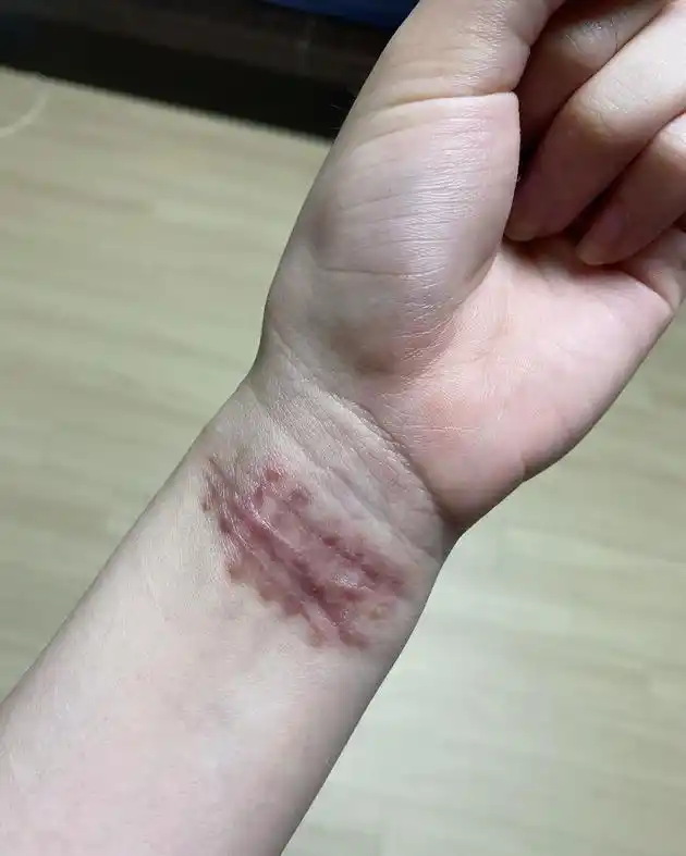 aoa权珉娥自曝被欺凌后发照 割手腕伤疤触目惊心