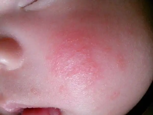 两个月的小孩得皮炎,可以放这两个药吗?