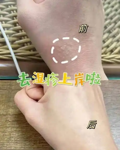 多年湿疹终于没了没有反复