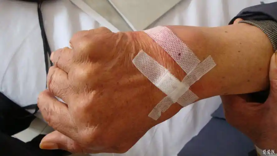 双侧腕关节疼痛肿胀4年,加重11天余