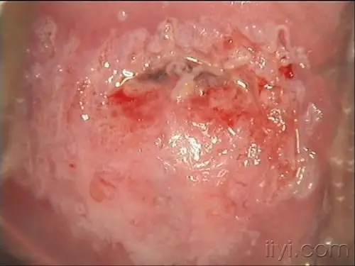 多张清晰的阴道镜图片(cin.尖锐湿疣.宫颈癌)