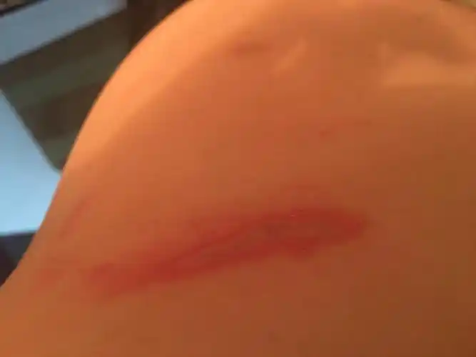 前天夜里睡觉感觉背痒用手抓了起床发现起了一条红带周围红