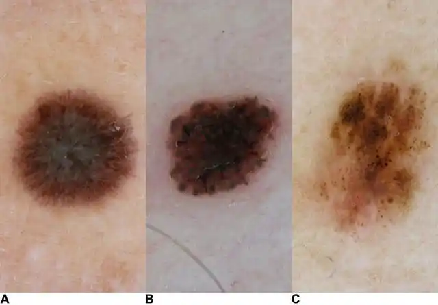 手把手教程:黑色素瘤的特殊皮肤镜表现